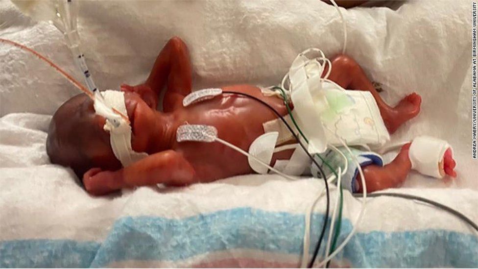 LifeNewsToo's tweet image. This is Curtis.
He was born 132 days early at just 21 weeks and holds the Guinness Record as the World's Most Premature Baby.
And now he's 4 years old!
He proves unborn babies are human beings who should NOT be killed in abortions.
lifenews.com/2025/01/29/wor…