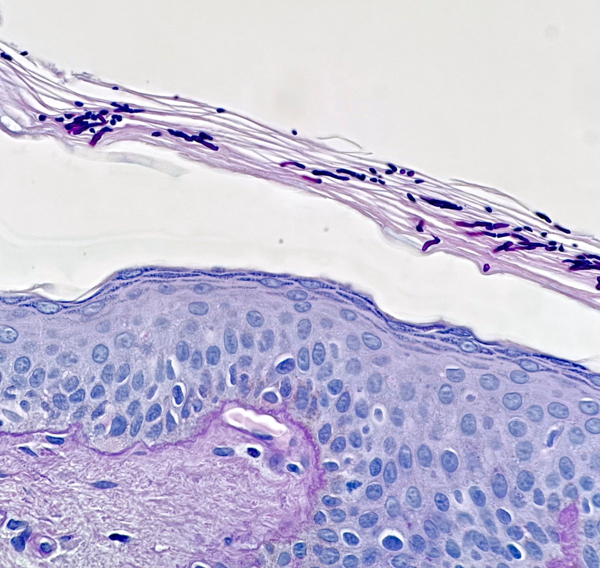 Happy Thursday 💖
#MalasseziaInfection
No PAS needed to view this yeast family 😉
Spaghetti and meatballs 
#PityriasisVersicolor
#dermatology 
#pathology