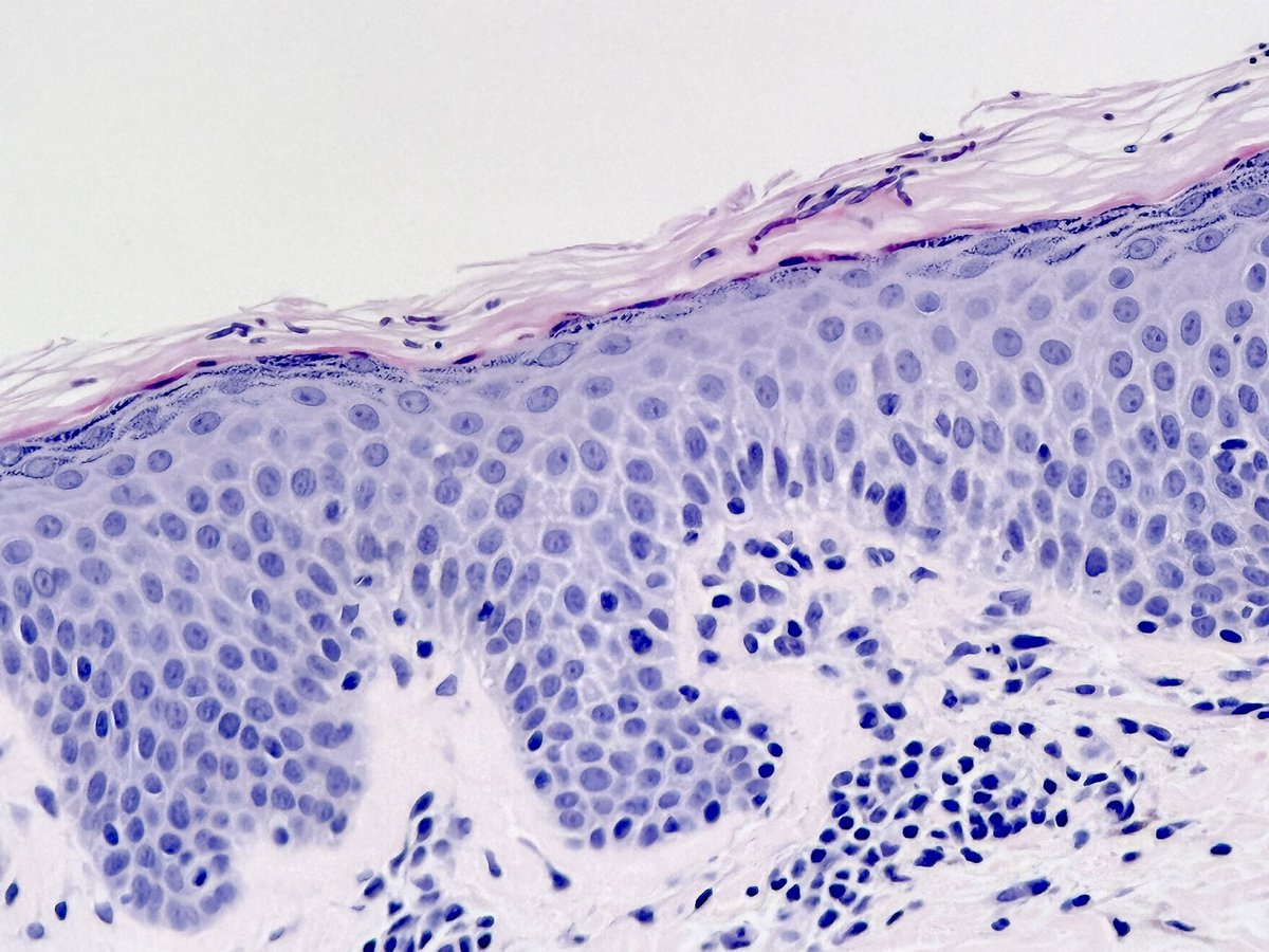 MBBS_Pathology's tweet image. Happy Thursday 💖
#MalasseziaInfection
No PAS needed to view this yeast family 😉
Spaghetti and meatballs
#PityriasisVersicolor
#dermatology
#pathology