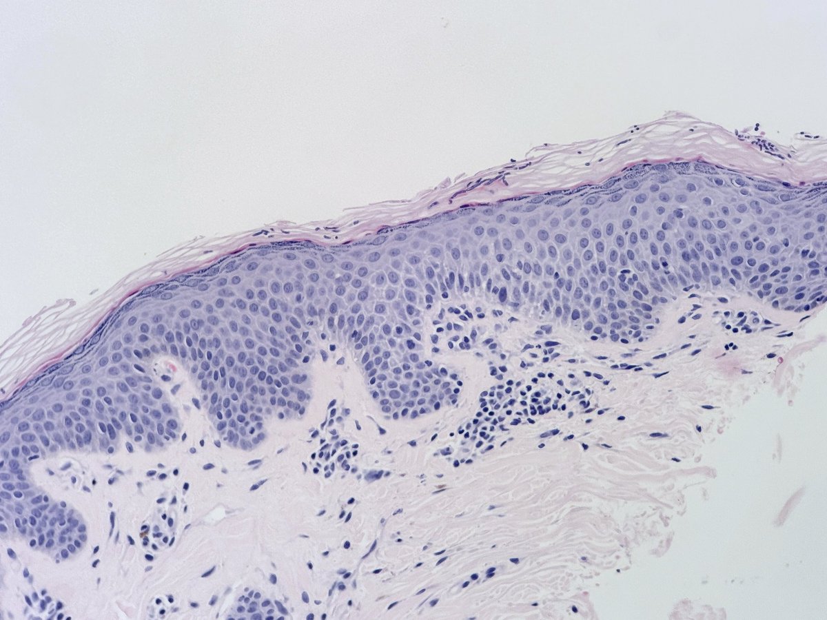 MBBS_Pathology's tweet image. Happy Thursday 💖
#MalasseziaInfection
No PAS needed to view this yeast family 😉
Spaghetti and meatballs
#PityriasisVersicolor
#dermatology
#pathology