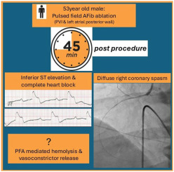 Diffuse right coronary artery spasm occurring forty-five minutes post pulsed field ablation for atrial fibrillation #OpenAccess

<a href="/vish_luther/">Dr Vishal Luther</a> <a href="/LiverpoolCCS/">Liverpool Centre for Cardiovascular Science</a> <a href="/LiverpoolEP/">Liverpool Heart Rhythm</a> <a href="/LHCHFT/">LHCH</a> <a href="/justinchiong_/">Justin Chiong</a> <a href="/DhirajGuptaBHRS/">Prof Dhiraj Gupta</a> 

heartrhythmjournal.com/article/S1547-…