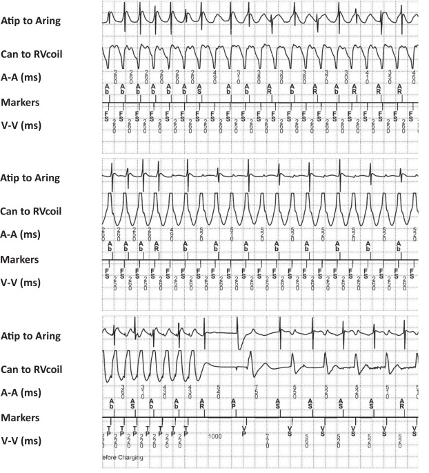 HeartRhythm (@hrs_journal) on Twitter photo Resistant Ventricular Tachycardia: What Are We Missing? #OpenAccess
@WongChris <a href="/Ed_Gerst/">Edward Gerstenfeld</a> <a href="/MelScheinman/">Mel Scheinman, MD</a> @Heart_UCSF <a href="/UCSFCardiology/">UCSF Cardiology</a> <a href="/UniofAdelaide/">Uni of Adelaide</a>
heartrhythmjournal.com/article/S1547-… Resistant Ventricular Tachycardia: What Are We Missing? #OpenAccess
@WongChris <a href="/Ed_Gerst/">Edward Gerstenfeld</a> <a href="/MelScheinman/">Mel Scheinman, MD</a> @Heart_UCSF <a href="/UCSFCardiology/">UCSF Cardiology</a> <a href="/UniofAdelaide/">Uni of Adelaide</a>
heartrhythmjournal.com/article/S1547-…