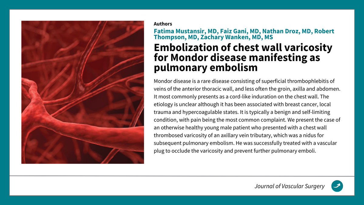 🩺New Publication Alert
“Embolization of chest wall varicosity for Mondor disease manifesting as PE.”
A rare case, a novel approach—clinical and research excellence in action.
👏 Congrats to our authors! bit.ly/44Qhm99

#VascularSurgery #WashUSurgery #MondorDisease