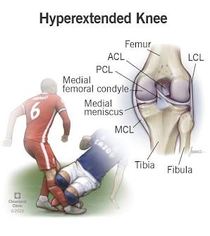 GameMedicine's tweet image. DeAndre Hopkins didn&apos;t practice today after suffering a mild knee injury yesterday. Hop landed awkwardly on a sideline route yesterday, tweaking his knee.

DeAndre probably hyperextended his knee on the landing overstretching a knee ligament. #RavensFlock