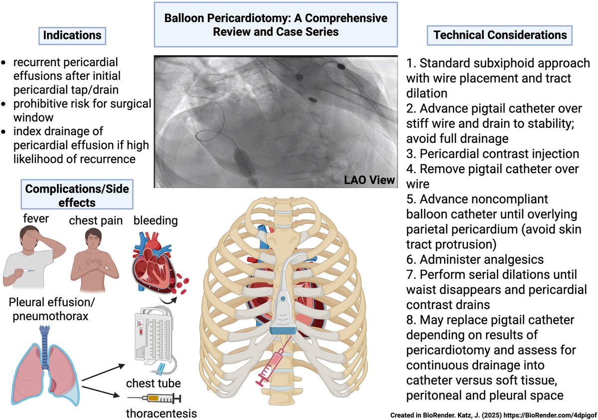 🔴Balloon Pericardiotomy:⤵️A Comprehensive #2025Review and Case Series #openaccess 

🔹jscai.org/article/S2772-…
 #Cardiology #FOAMed #MedEd #medstudent #paramedic #Cardiology #CardioEd #medtwitter #meded #CardioTwitter #cardiotwiteros  #MedX #cardiovascular
