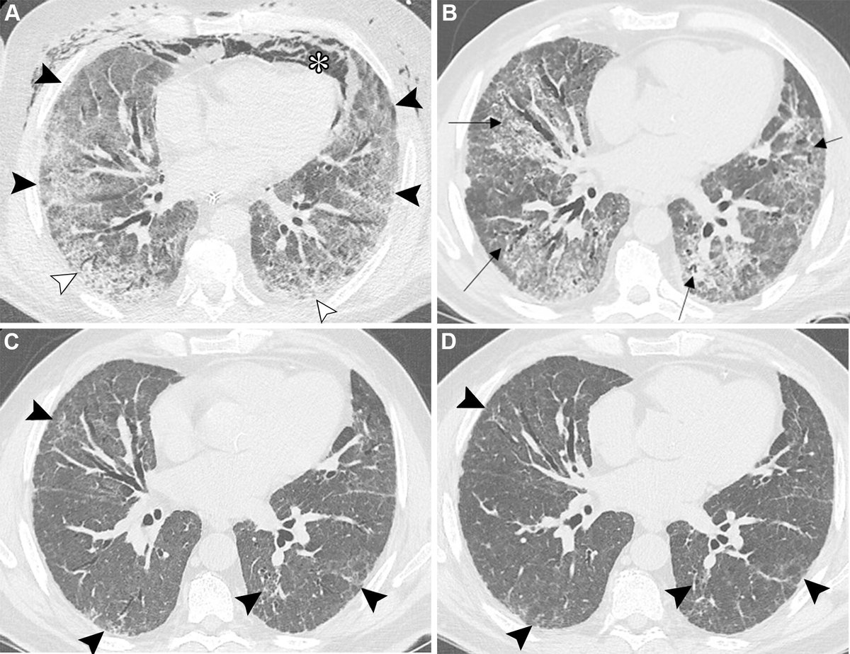 Radiology (@radiology_rsna) on Twitter photo Residual lung abnormalities at CT after COVID-19 infection may be associated with persistent or progressive respiratory symptoms, particularly in patients hospitalized with moderate to severe acute pneumonia. <a href="/SNU_Rad/">SNU Radiology</a> bit.ly/4eZkOmh Residual lung abnormalities at CT after COVID-19 infection may be associated with persistent or progressive respiratory symptoms, particularly in patients hospitalized with moderate to severe acute pneumonia. <a href="/SNU_Rad/">SNU Radiology</a> bit.ly/4eZkOmh