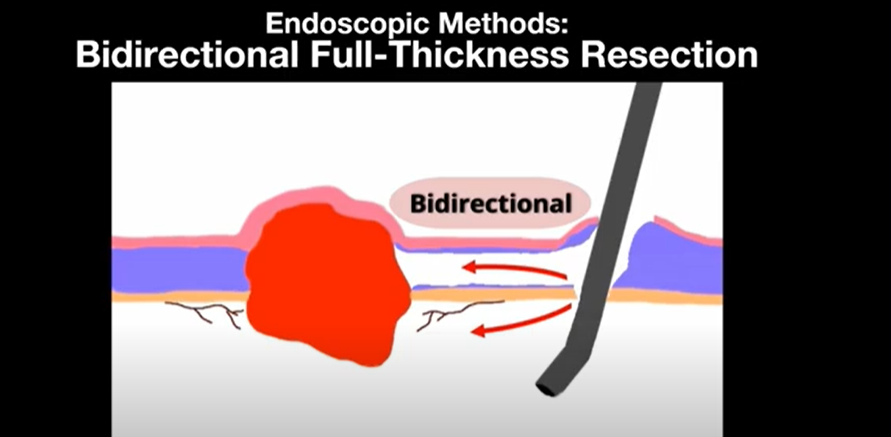 iGIEjournal's tweet image. From iGIE YouTube: Farimah Fayyaz, MD, et al show a modified endoscopic full-thickness resection technique (bidirectional full-thickness resection) for addressing challenges in resection of exophytic lesions. youtu.be/0iG8Z7JOopM
#GITwitter
@MouenKhashab
@gutdoc18