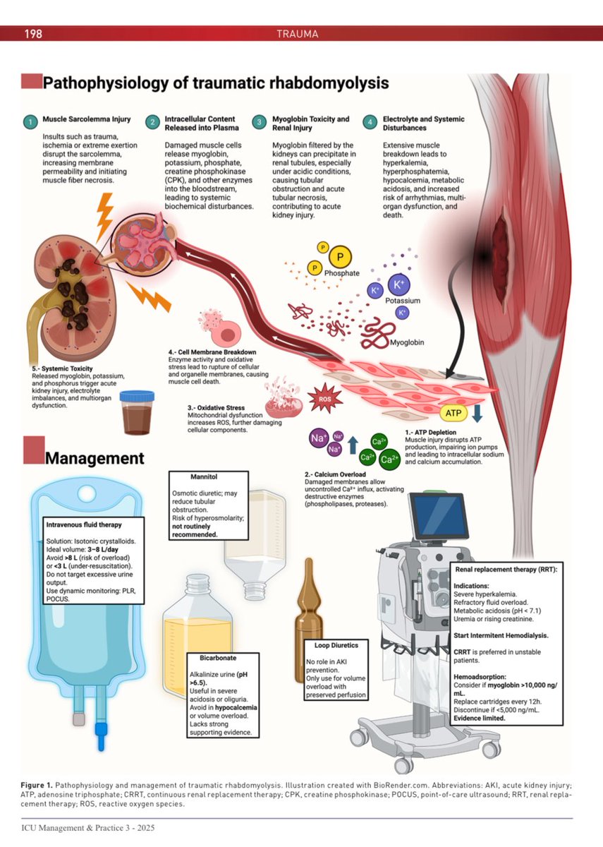 TODO lo que un Urgenciólogo e Intensivista necesita saber sobre RABDOMIÓLISIS por Trauma (CRUSH 🌟)

🍖 Fisiopatología
🍖 Diagnóstico
🍖 Tratamiento

Descárgalo gratis: healthmanagement.org/c/icu/issueart…