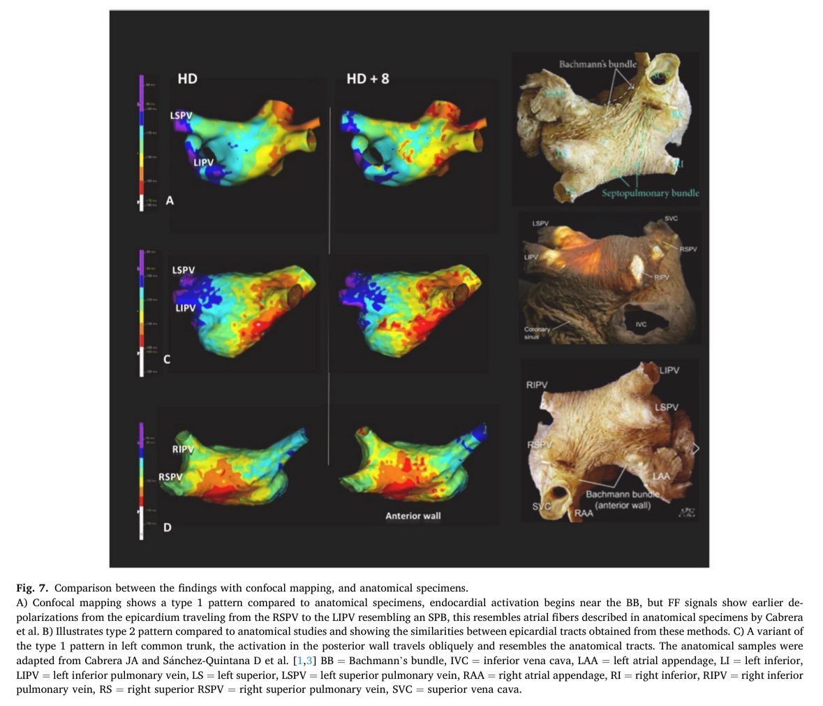 Our latest article describing a novel “confocal” technique to map LA activation just published <a href="/JElectrocardiol/">Journal of Electrocardiology</a> <a href="/jacabreracardio/">Dr. José Ángel Cabrera</a> <a href="/adribaran/">Adrian Baranchuk MD FACC FRCPC FCCS FSIAC</a> <a href="/kapicarrizales/">Edgar Carrizales</a>