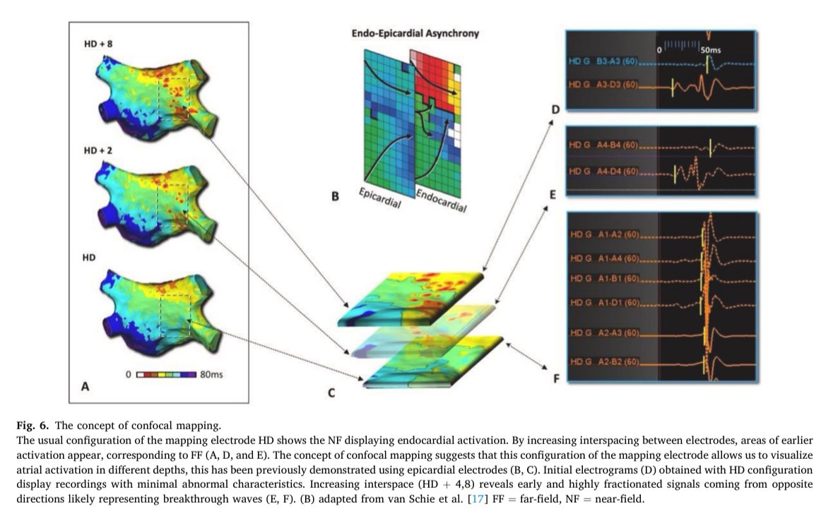 arritmiasmx's tweet photo. Our latest article describing a novel “confocal” technique to map LA activation just published @JElectrocardiol @jacabreracardio @adribaran @kapicarrizales https://t.co/fyouWsVkbn