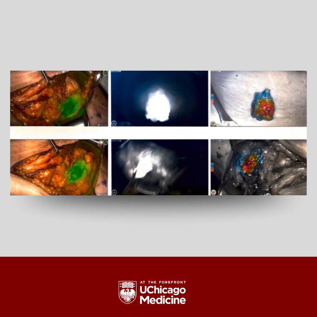 uchicago_obgyn's tweet image. New from UChicago OB/GYN: Drs. Perinchery (PGY3) and Mills review sentinel lymph node mapping in vulvar and cervical cancers in @gynoncjnls, highlighting clinical evidence, surgical techniques and institutional insights.
Read: sciencedirect.com/science/articl…