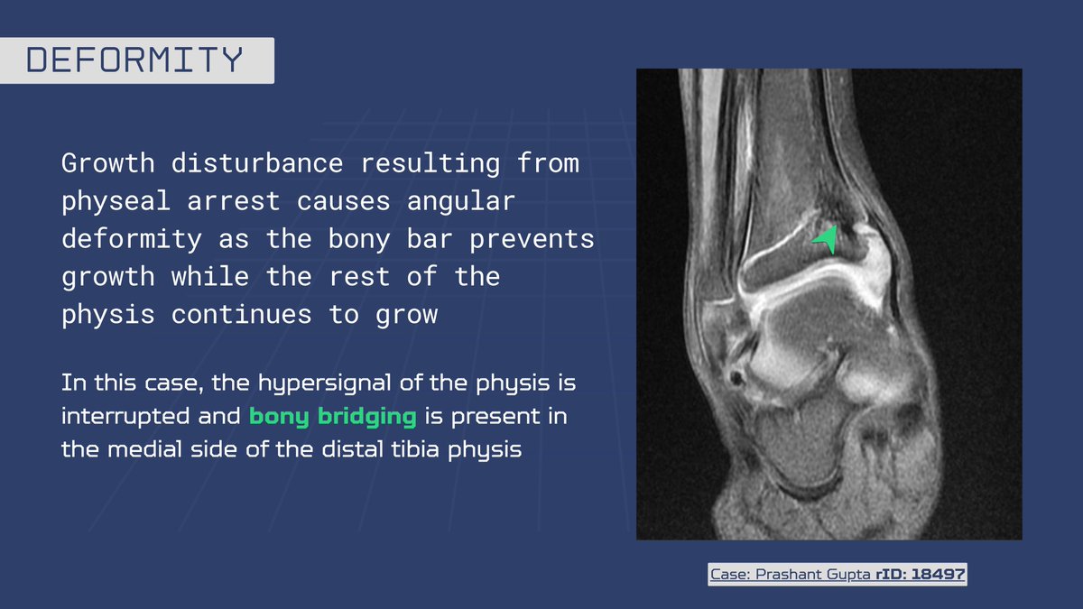 Leonardo Lustosa 🦴 (@drleolustosa) on Twitter photo Glad to share that I was awarded Most Outstanding Paediatric imaging rPoster for #Radiopaedia2025 🥹
🔗 You can check the full presentation here: doi.org/10.53347/rPost…
By the way, you may still register for the conference and catch up with all the lectures on-demand 😉 Glad to share that I was awarded Most Outstanding Paediatric imaging rPoster for #Radiopaedia2025 🥹
🔗 You can check the full presentation here: doi.org/10.53347/rPost…
By the way, you may still register for the conference and catch up with all the lectures on-demand 😉