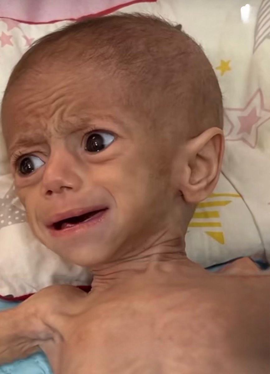 🟥 ماذا تبقّى من سوار؟

الرضيعة سوار عاشور لم تكمل شهرها الخامس…
تحوّلت إلى هيكلٍ نحيل تنهشه آلام الجوع وسوء التغذية الحاد.
وُلدت تحت القصف، في زمن لا يُطعم، لا يُداوي، ولا يرحم.

أمها جائعة، أبوها كفيف، والحصار يخنق أنفاسها الصغيرة.
لا حليب… لا دواء… ولا حضن دافئ.

سوار تحتضر