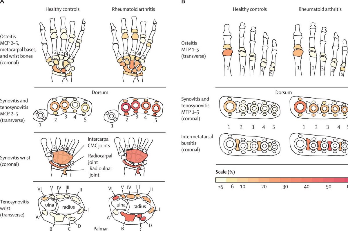MRI changes in *normal* joints Vs #RA
 
MRI sensitivity is high but what about specificity ? 🧐

🆕
<a href="/TheLancetRheum/">The Lancet Rheumatology</a> study by Dennis Ton and colleagues