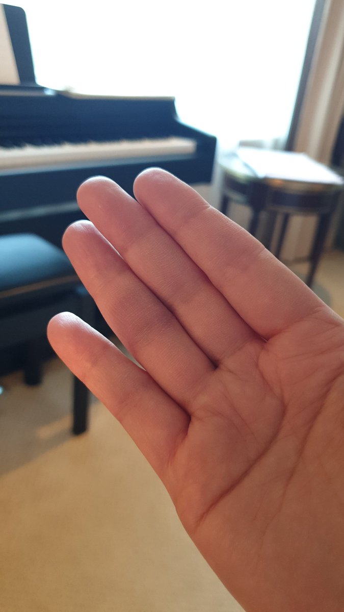 bakanakov's tweet image. 朝起きたら右手の薬指にナゾのあざが出来ていた件🤔 一体どんな姿勢で寝てたんだ？？