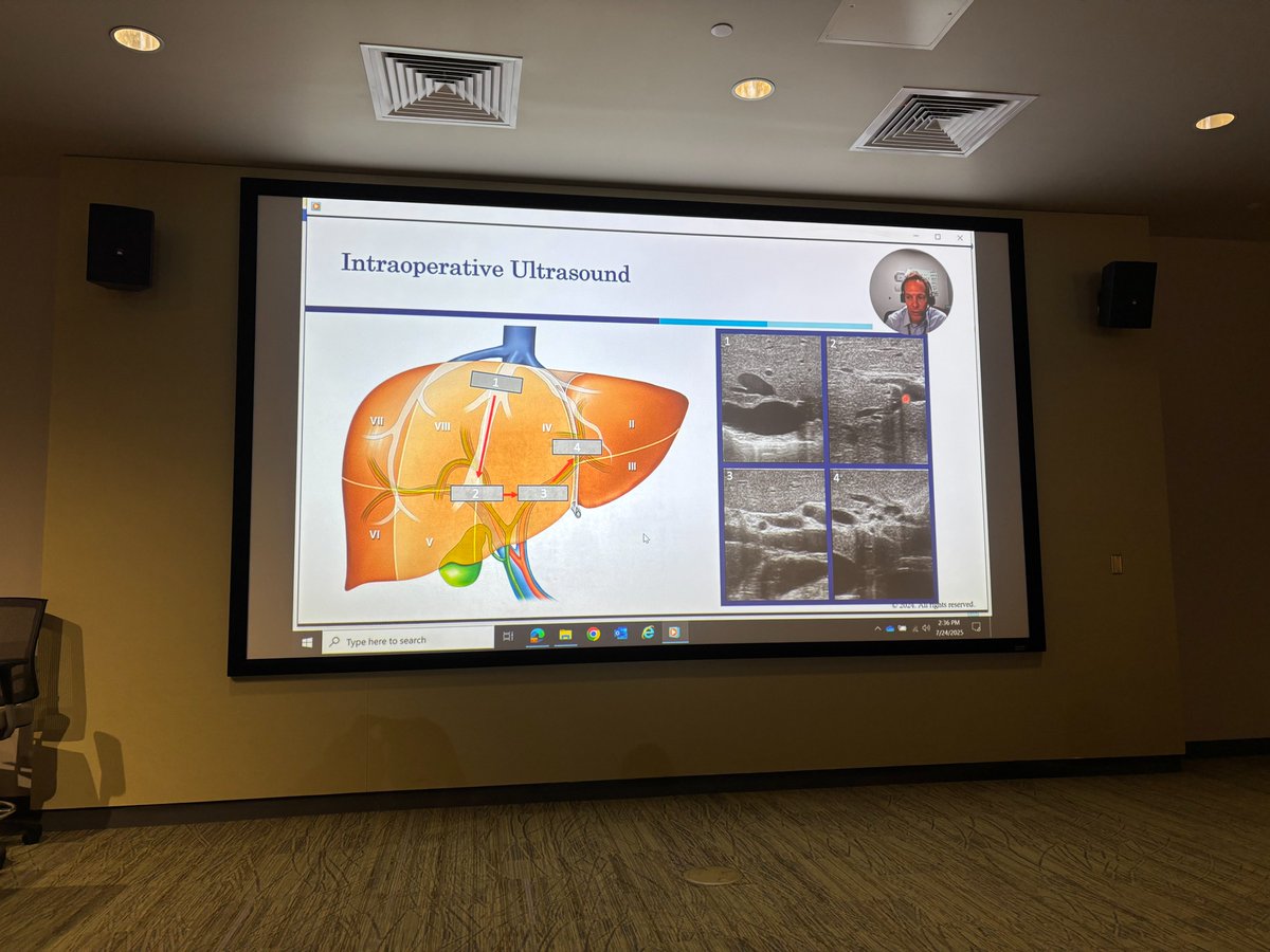 EAVegaMD's tweet image. Great first day at the 5th Annual Complex HPB Course! Incredible cadaveric labs and engaging talks with upcoming CGSO fellows @SocSurgOnc. Such a high-level, hands-on learning experience. @MoffittNews @DanielAnayaMD @DenboJw @AHPBA @SSATNews @hpb_so @MHepatobiliary…