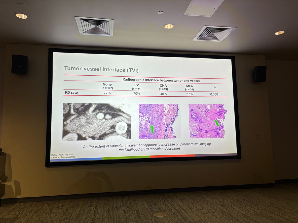 EAVegaMD's tweet image. Great first day at the 5th Annual Complex HPB Course! Incredible cadaveric labs and engaging talks with upcoming CGSO fellows @SocSurgOnc. Such a high-level, hands-on learning experience. @MoffittNews @DanielAnayaMD @DenboJw @AHPBA @SSATNews @hpb_so @MHepatobiliary…
