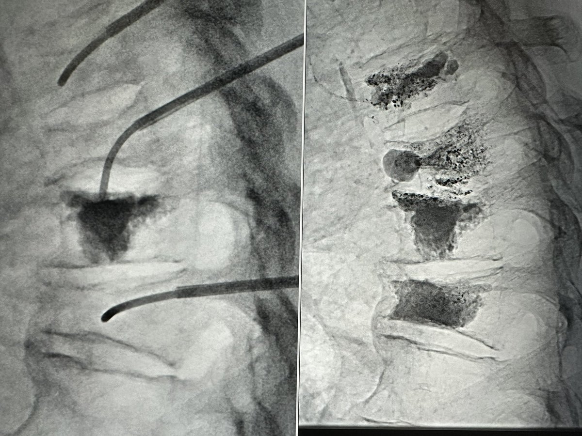 Jacob Fleming, MD (@jacobflemingmd) on Twitter photo Curved needles and cement cannulas are helpful for targeting focal fracture clefts. Small T8 superior endplate cleft after otherwise sufficient kypho at OSH was not amenable to pedicular access. Transdiscal access from above made for an easy fix. Curved needles and cement cannulas are helpful for targeting focal fracture clefts. Small T8 superior endplate cleft after otherwise sufficient kypho at OSH was not amenable to pedicular access. Transdiscal access from above made for an easy fix.
