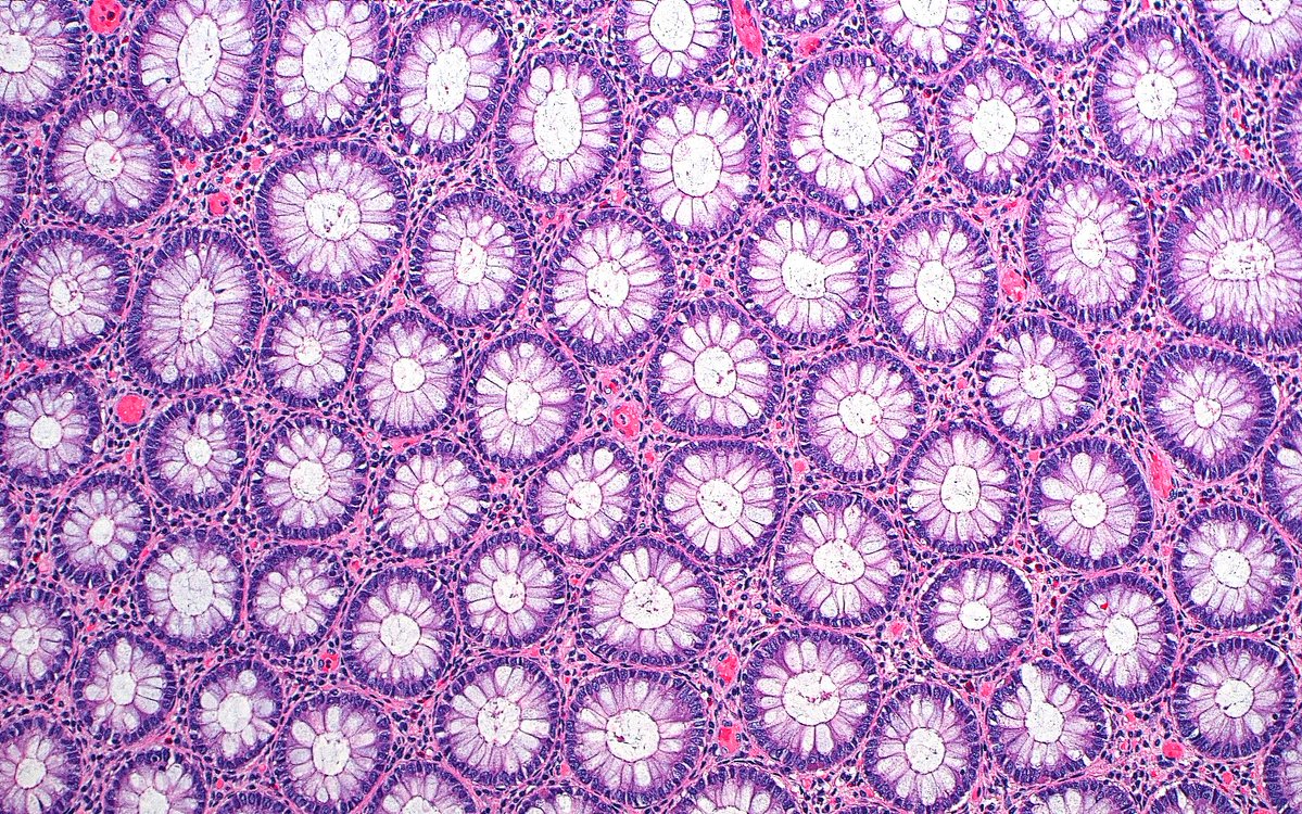 ziad_zaatari's tweet image. 🔬📷🎨 Classic, basic, and beautiful...and never fails at making me stop to take a photo! ~ Normal Colonic Crypt Cross Sections: "A Sea of Flowers" 🌼🌸
#Pathology #Histology #PathArt