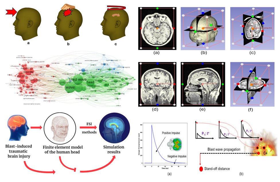 medntdj's tweet image. Interface-driven human brain injury mechanisms in blast exposure: A fluid–structure interaction model
sciencedirect.com/science/articl…
#Blast-induced traumatic brain injury #Shear stressFinite element modeling #Brain biomechanics #Diffuse axonal injury #MedTwitter #scicomm #MedEd