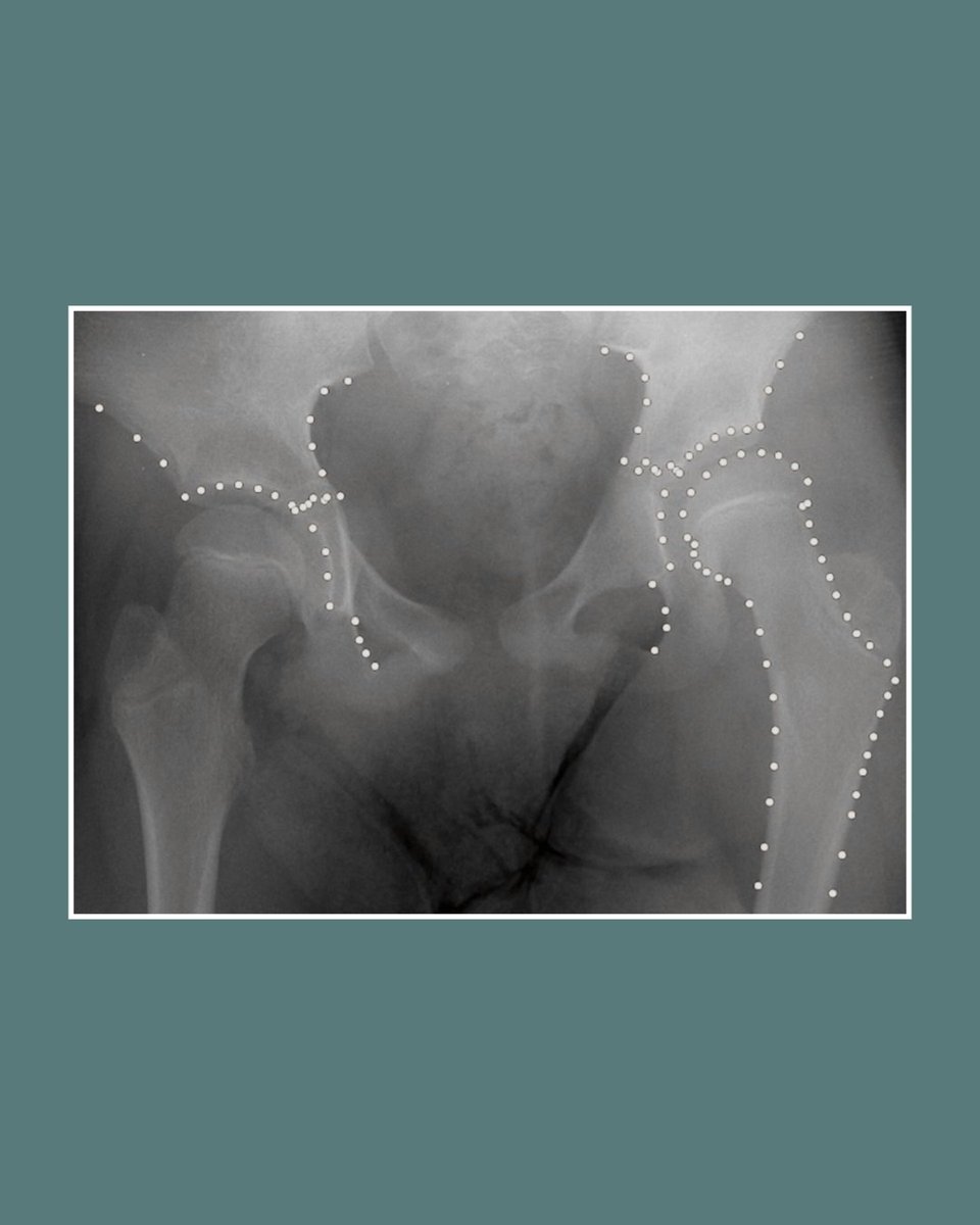 BoneJointJ's tweet image. This paper shows that the machine learning tool BoneFinder can automatically calculate Reimers migration percentage and head-shaft angle with similar accuracy to clinicians.
#MachineLearning #CerebralPalsy #Pediatrics
ow.ly/q3Wo50WkiJa