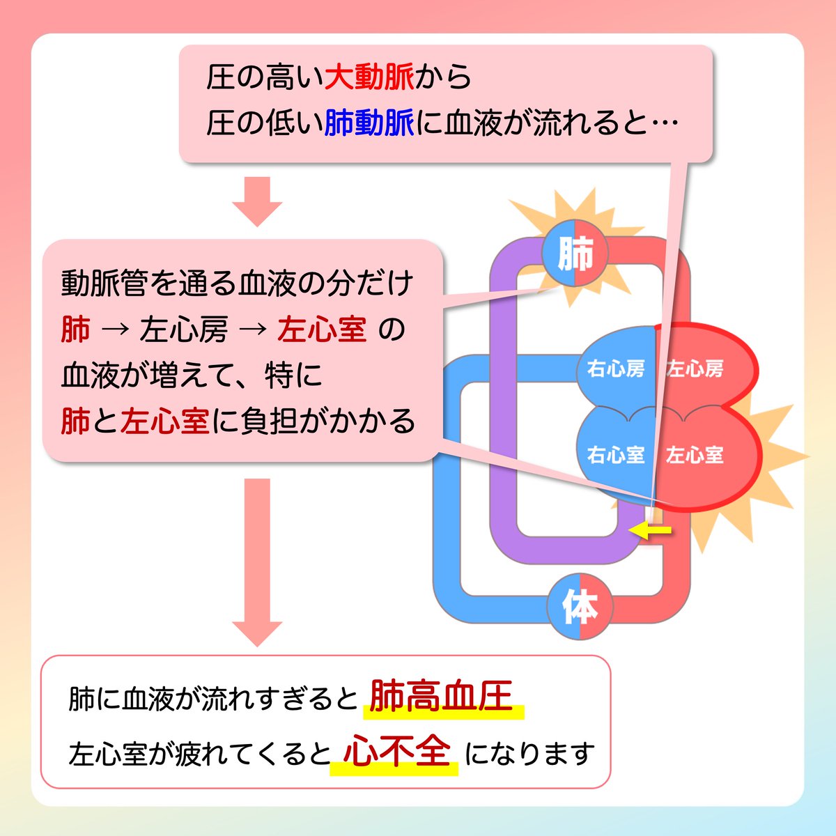 JSPCCS's tweet image. 【公式Instagramより】
 
❤️子どもの心臓病の解説 ❤️

＼動脈管開存症の症状！／

動脈管開存症はどんな症状で、
どうしてそのような症状が出るのか、
について説明します。

♡･････♡･････♡･････♡･････♡･････♡
詳しい内容は…
日本小児循環器学会一般向けホームページ…