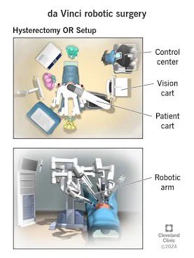 PatrickMoorhead's tweet image. Some say robotics are a long way away. This morning, I will have a robot perform surgery on an inguinal hernia I have had for 30 years. This is a human in the loop surgery, taking around an hour. While I’m sad I won’t be able to lift at all for 2 weeks, heavy for a month or two,…