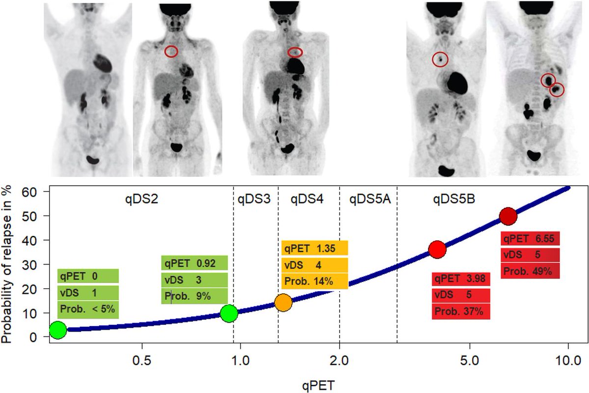 JournalofNucMed's tweet image. Can a quantitative extension of the visual 5-point Deauville scale, known as qPET, allow for better prognostic discrimination? Read more: ow.ly/x5Mg50WoMfz 

#NuclearMedicine #NonHodgkinLymphoma #PETscan @JamieFlerlage @LopciEgesta
