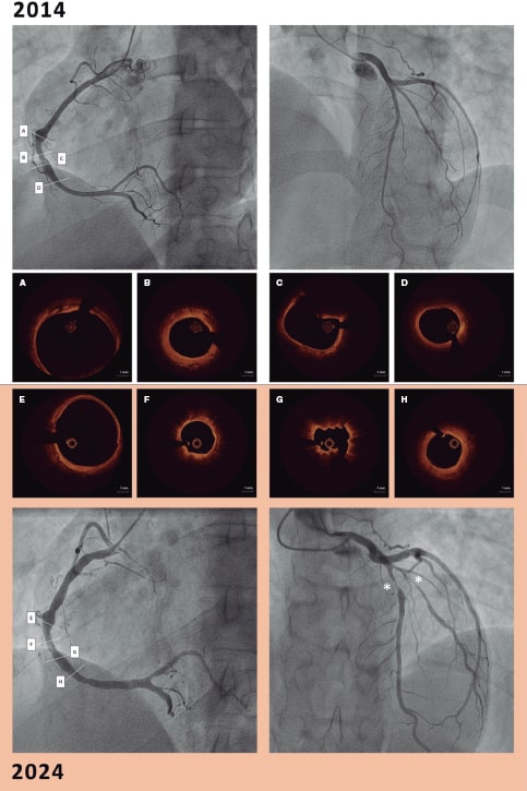 RevEspCardiol's tweet image. Diez años de seguimiento de enfermedad coronaria por vasculitis #recintervcardiol #Aheadofprint @carlosreal42 @pabl0salinas recintervcardiol.org/es/imagenes-en…