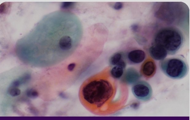 ABC Of Cytology Revision -3
D: Diethylstilbestrol.
Got this image from BAC page.  PAP smear  from a patient with vaginal adenosis.
The generational effect of diethylstilbestrol is well documented.  Image  no doubt HSIL. However, histology  reported to be Low Grade. Am curious.