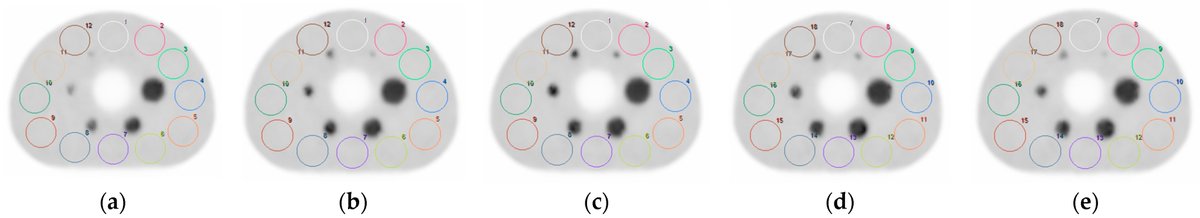 📈Highly Accessed Paper📈

💡"Evaluation of the Characteristics of Short Acquisition Times Using the Clear Adaptive Low-Noise Method and Advanced Intelligent Clear-IQ Engine" by Ryosuke Ogasawara et al.

🔗Read it here: mdpi.com/2673-592X/5/2/…

#Radiation #OpenAccess #MDPI