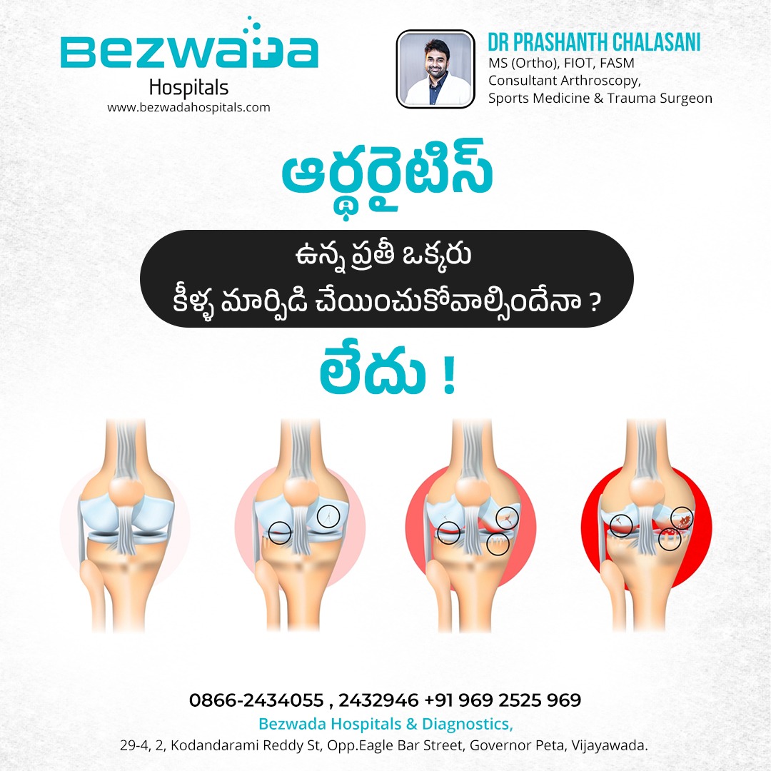 BezwadaHospital's tweet photo. Not everyone with arthritis needs knee replacement—treatment depends on the severity and daily impact.
#Affordable #Reliable 
#BezwadaHospitals #Vijayawada #OrthopedicSurgeons 
Walk in to Consult #DrPrashanthChalsani 

Call +91 96 92 52 59 69
Website: https://t.co/j41uo1Pzvb https://t.co/6hzIHl7D6U