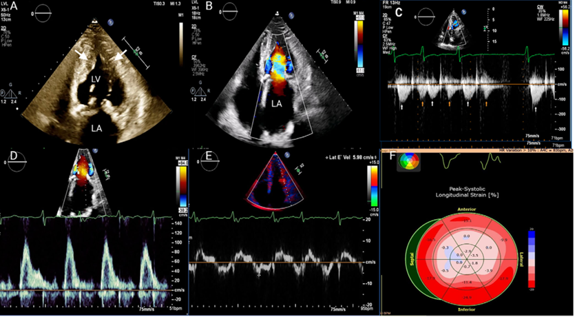 cardioteca's tweet photo. 🆕 Miocardiopatía hipertrófica apical: Diagnóstico clínico y por imagen.

📕 Echocardiography
📁 Resumen del artículo en https://t.co/cFLklZXPhA https://t.co/lRX4j2xsBl
