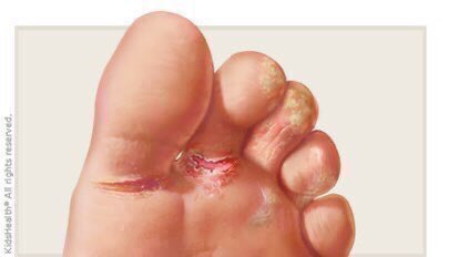 safonyameherbal's tweet photo. Your ATHLETE’S FOOT DISEASE (eyun in Yoruba, apropro in twi) vanishes within 4 to 7 days after using Cassia alata (Yoruba=Asunwon oyinbo, twi=osimpe)..

Mash the leaves and apply the liquid extract on the the affected toes or foot🍀 https://t.co/vy3qe2I3Cd