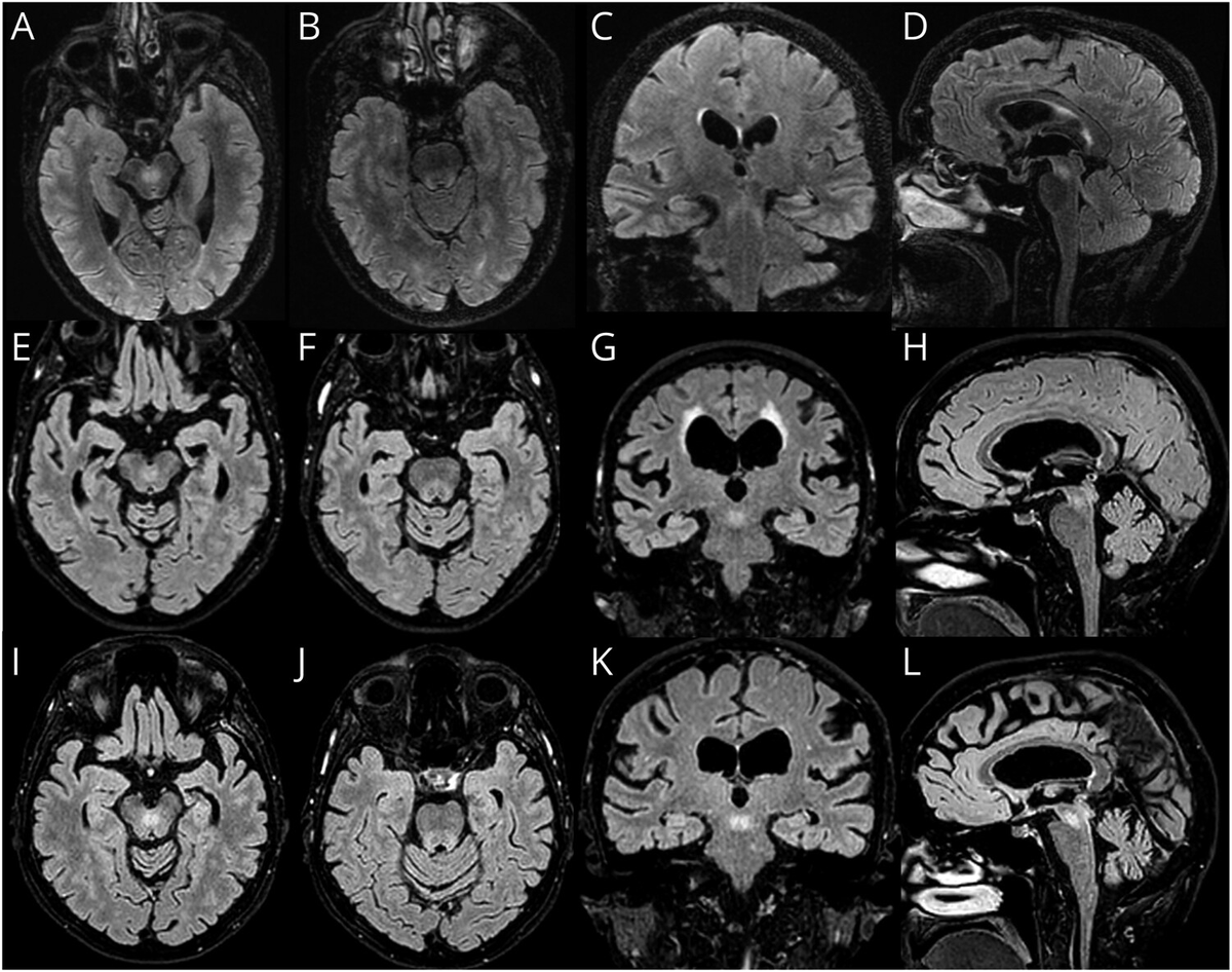 piandro3142's tweet image. Clue to spinocerebellar ataxia 27B (SCA27B): may have high T2/DWI signal in the superior cerebellar peduncles and its decussation. Seen in around half of patients!
Reading:
- neurology.org/doi/10.1212/NX…
- link.springer.com/article/10.100…