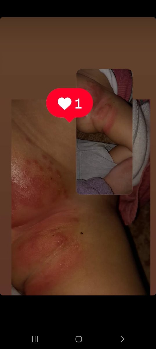 mahmoodhab3083's tweet image. This is my baby girl Sila. We used plastic bags instead of diapers. Now she cries in pain from severe rashes.
She needs urgent medicine. Please help — no child should suffer like this. 💔
#SaveSila #GazaChildren
chuffed.org/project/138887