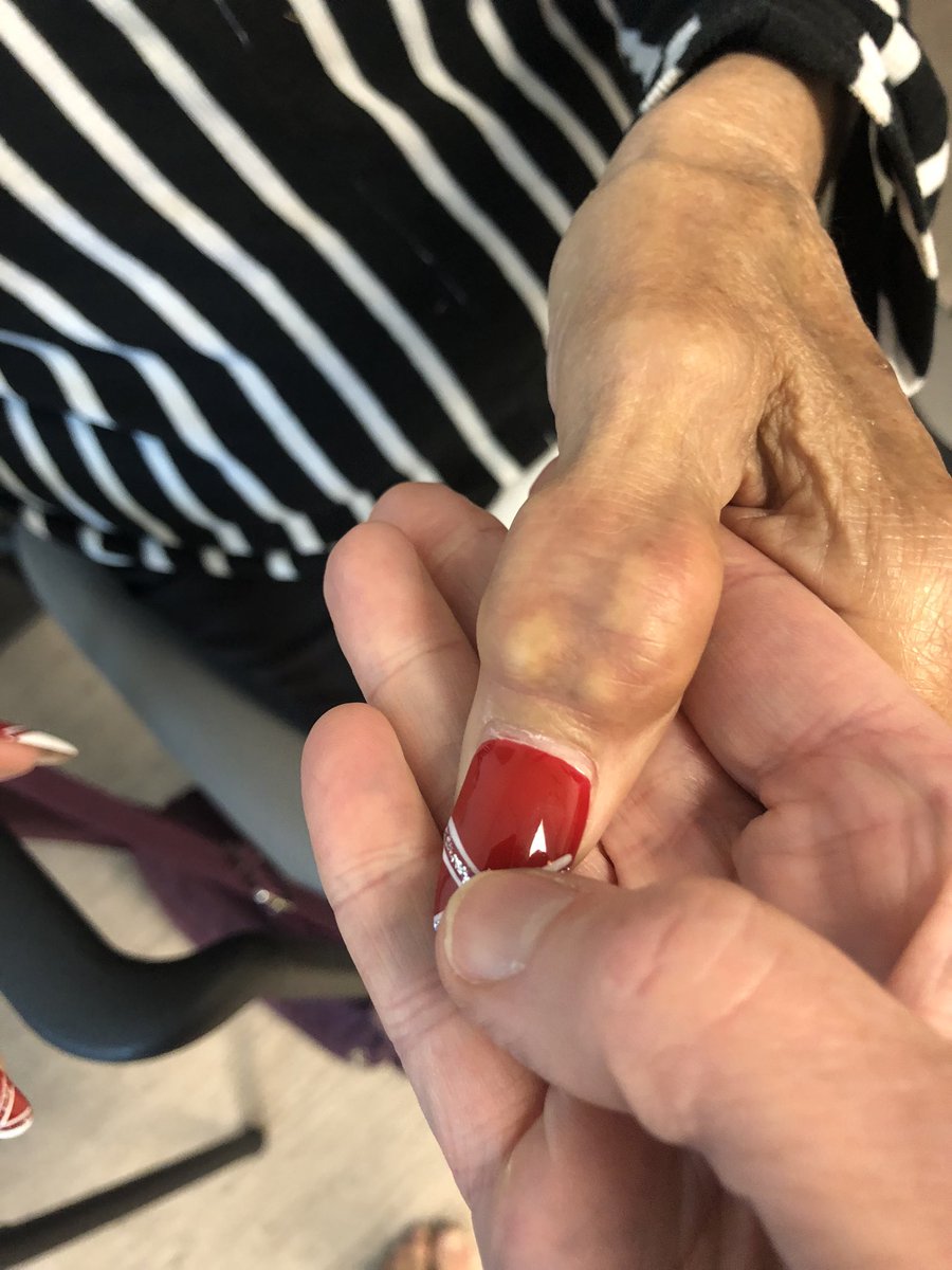 Janetbirdope's tweet photo. #ClinicalPearl 

#Lumps in IP /DIP

What is the top #dx

#Diagnosis in 1 #picture

Hint 
Note white subcutaneous color https://t.co/SI7Asyk7PP