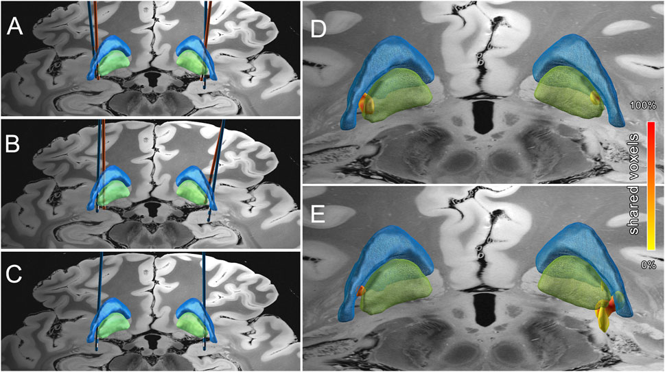 Joshua Wong (@jwongggmd) on Twitter photo Great report by Dr Matt Remz on DBS programming for DYT-11 dystonia. It can be quite challenging and perhaps electrophysiology can help guide this process
Read it here at the official <a href="/dmrf/">Dystonia Medical Research Foundation</a> journal
frontierspartnerships.org/journals/dysto… Great report by Dr Matt Remz on DBS programming for DYT-11 dystonia. It can be quite challenging and perhaps electrophysiology can help guide this process
Read it here at the official <a href="/dmrf/">Dystonia Medical Research Foundation</a> journal
frontierspartnerships.org/journals/dysto…