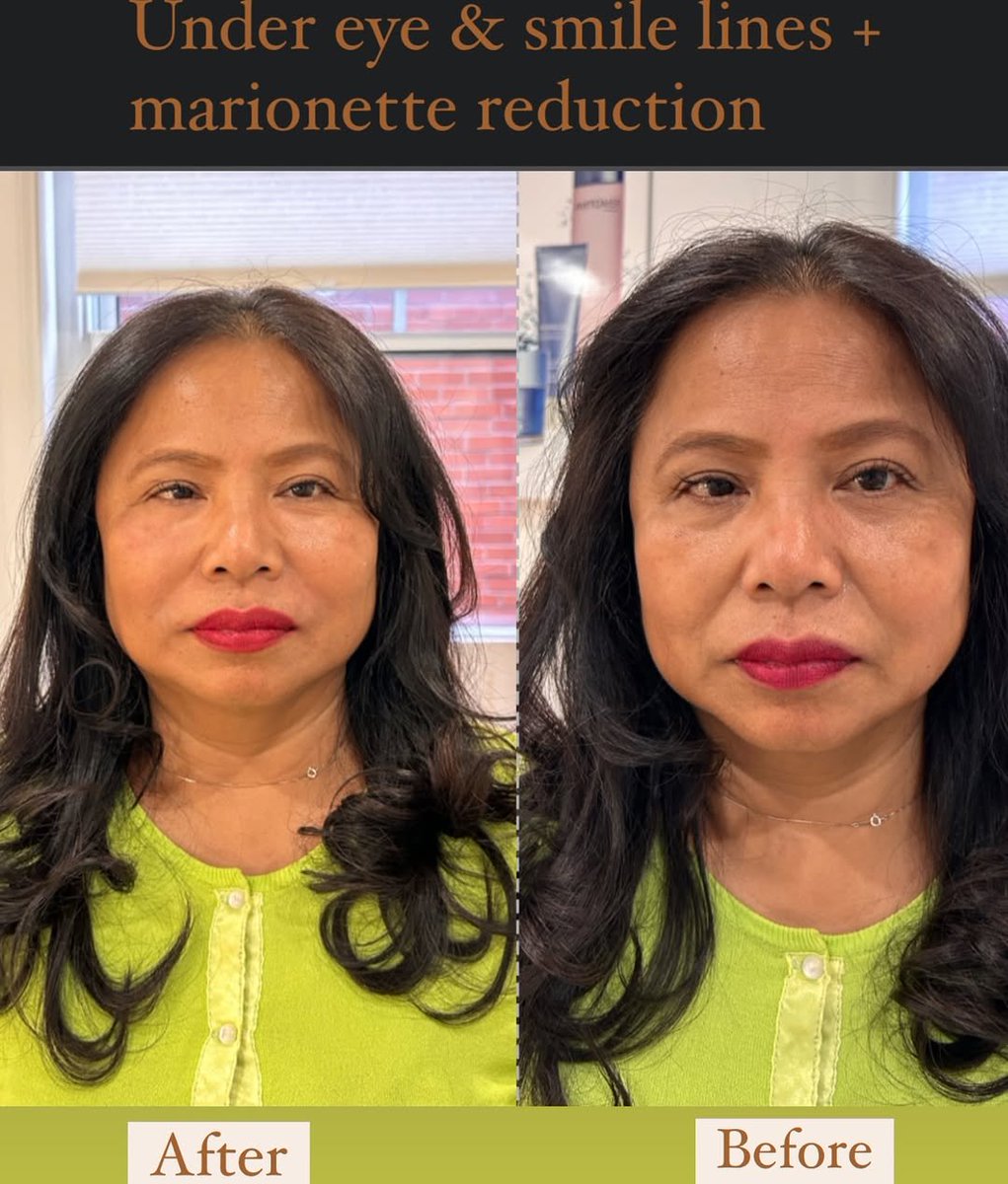 edi_rose1's tweet image. If you always have a tired face . You may consider this treatment . ( this is only partial session , follow up will be done within two weeks prior to the treatment 😉)#TiredNoMore #SkinRefresh