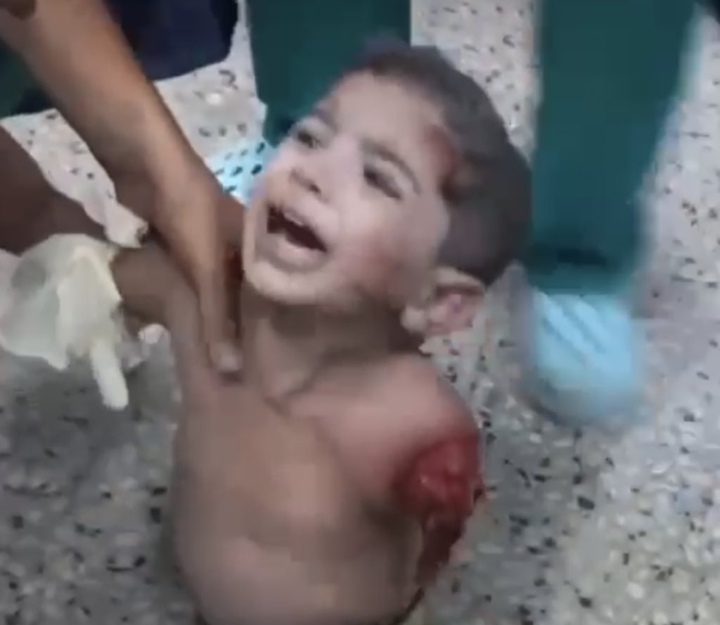 This boy lost his hand in Israeli bombing of a displacement centre in Gaza!