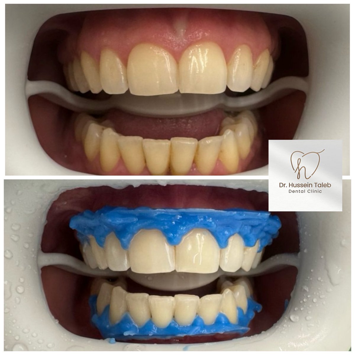 DrHusseinTaleb's tweet image. โจ A brighter, more confident smile in just one session!
Protective isolation โ๏ธ
Professional-grade whitening gel โ๏ธ
Visible results โ๏ธ
Book your whitening session today and let your smile shine!
๐Dr. Hussein Taleb Dental Clinic โ Al Hosh, Tyre
#TeethWhitening