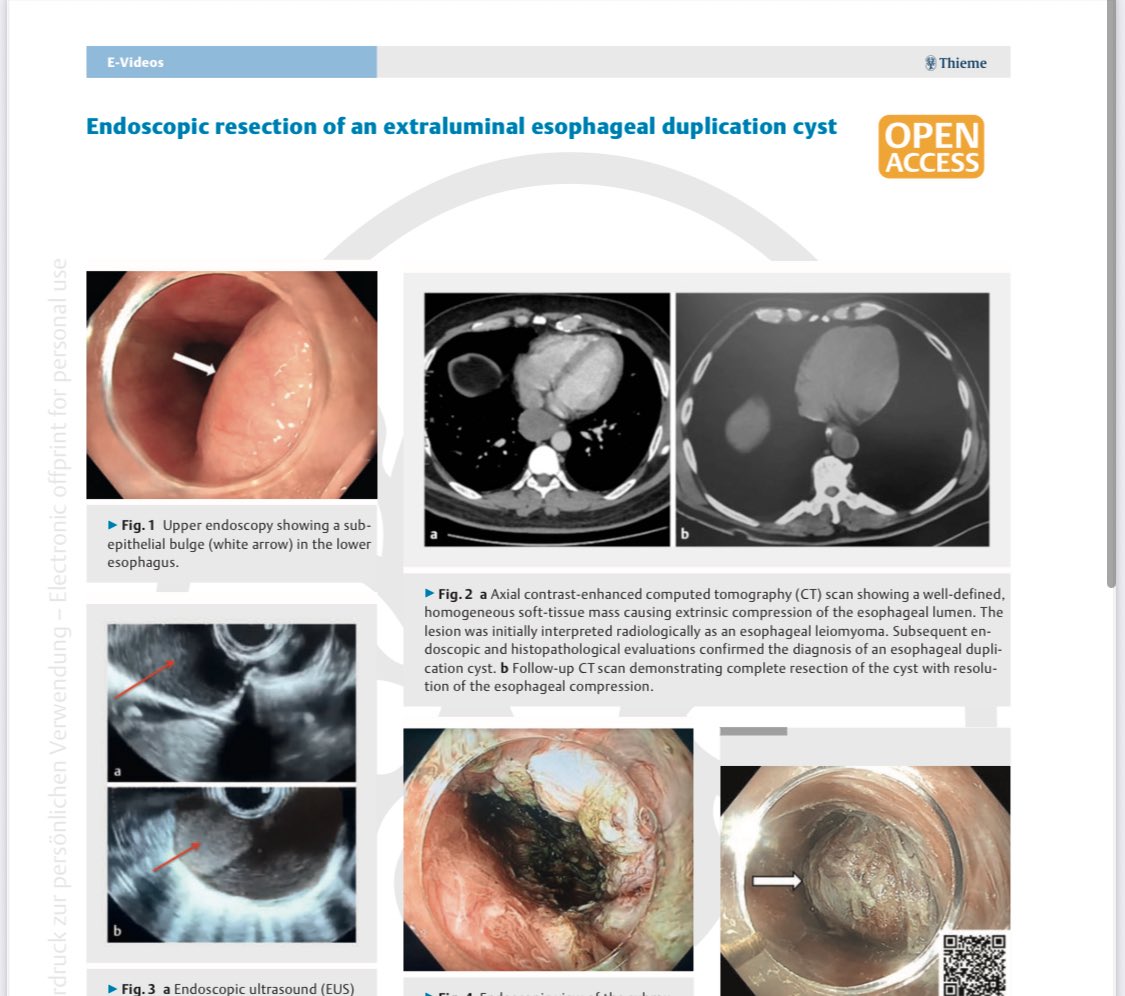 Pushing the limits of endoscopy  ..
Our new publication about endoscopic resection of extra-luminal duplication cyst using STER .. published in @Endoscopy Journal  the official journal of @European Society of Gastrointestinal Endoscopy (ESGE) <a href="/endoscopy/">1800endoscope.com</a>jrnl <a href="/ESGE_news/">ESGE</a> 
Done by