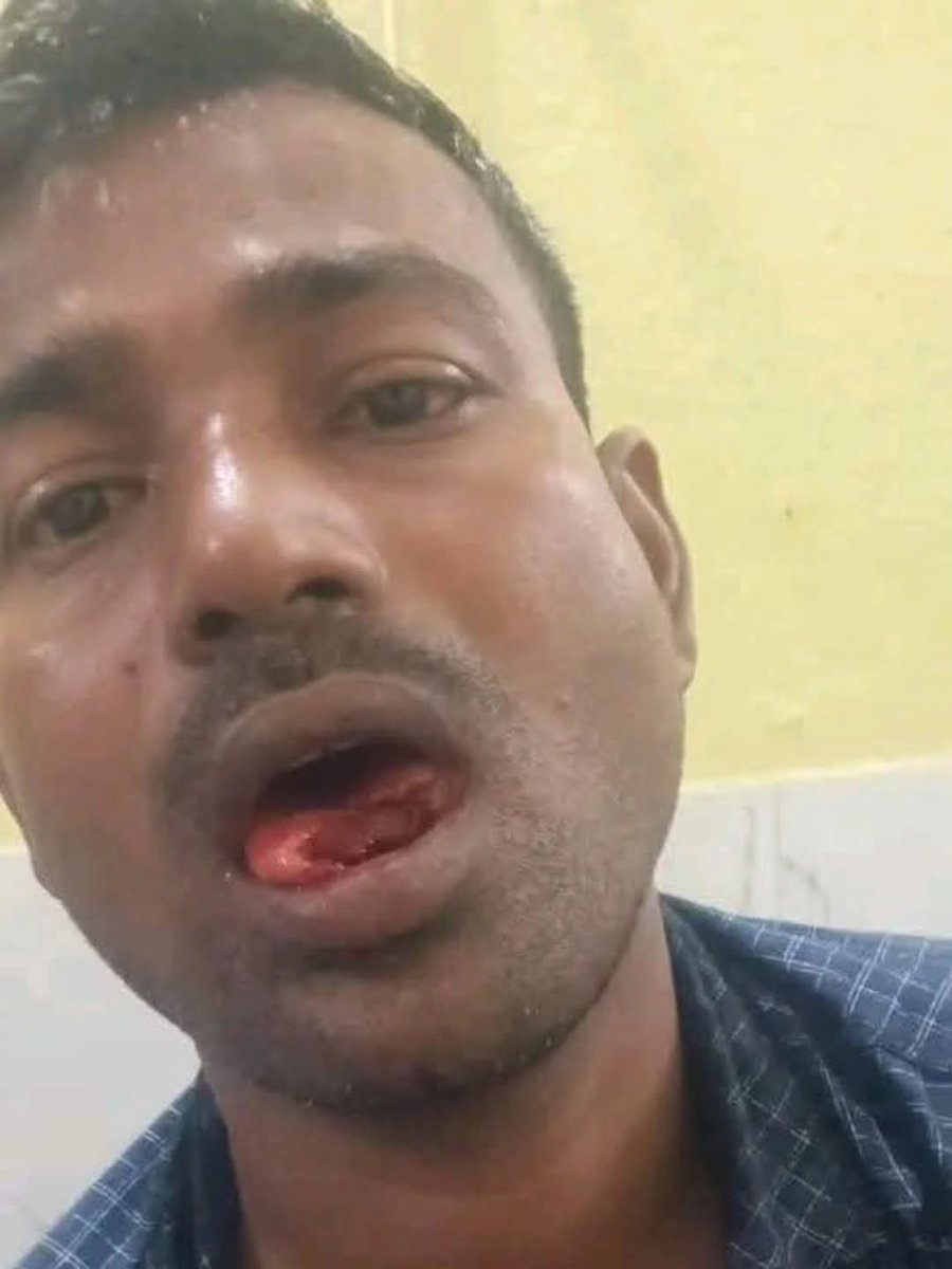 ShayarShahnawaz's tweet image. बिहार में एक अनोखा वारदात सामने आया है।
एक मामूली नोक झोंक में पत्नी ने पति की चीभ को काट कर अलग कर दी।
