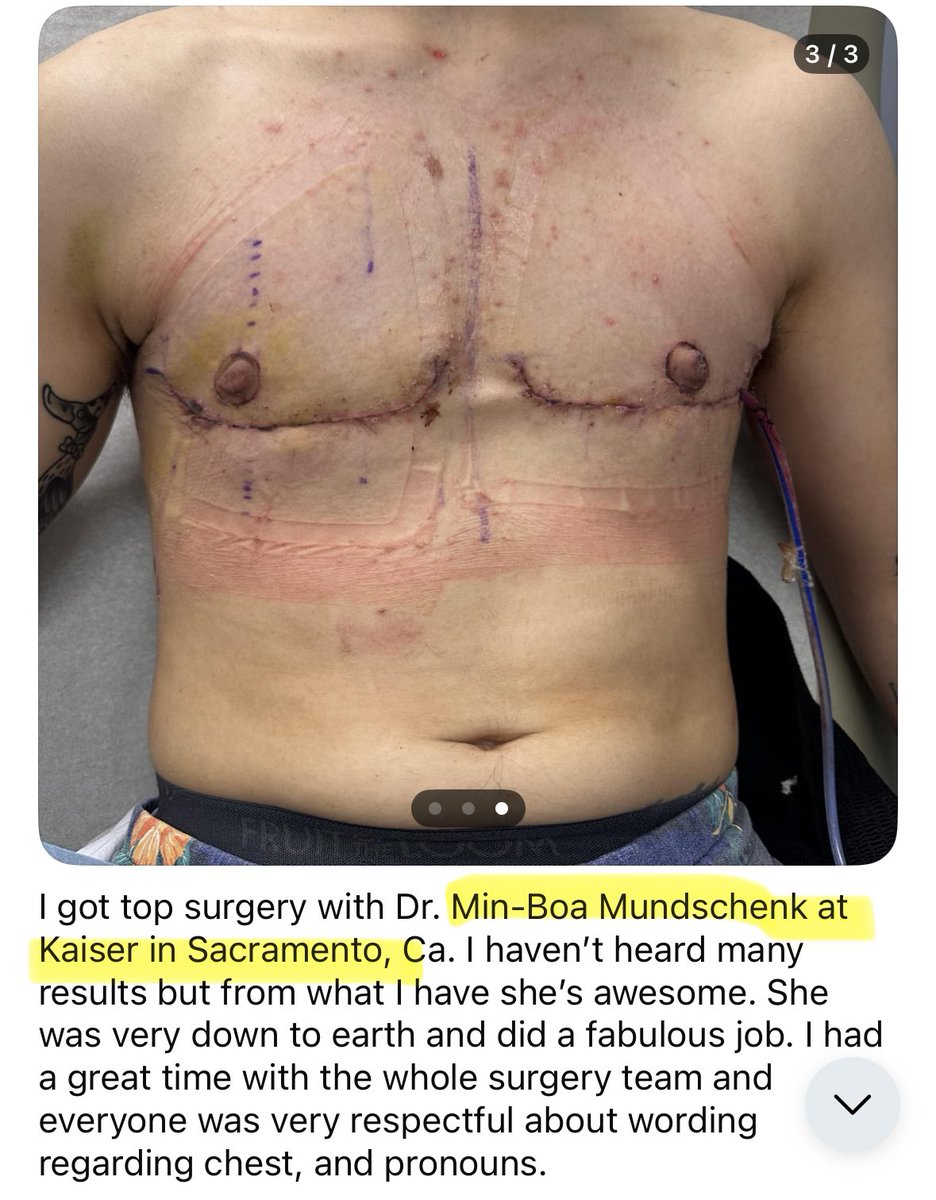bourne_beth2345's tweet image. You can find dozens of reviews online of Dr. Minh-Bao Mundschenk’s “top surgery” results. 

This is a horrific social-medical scandal.