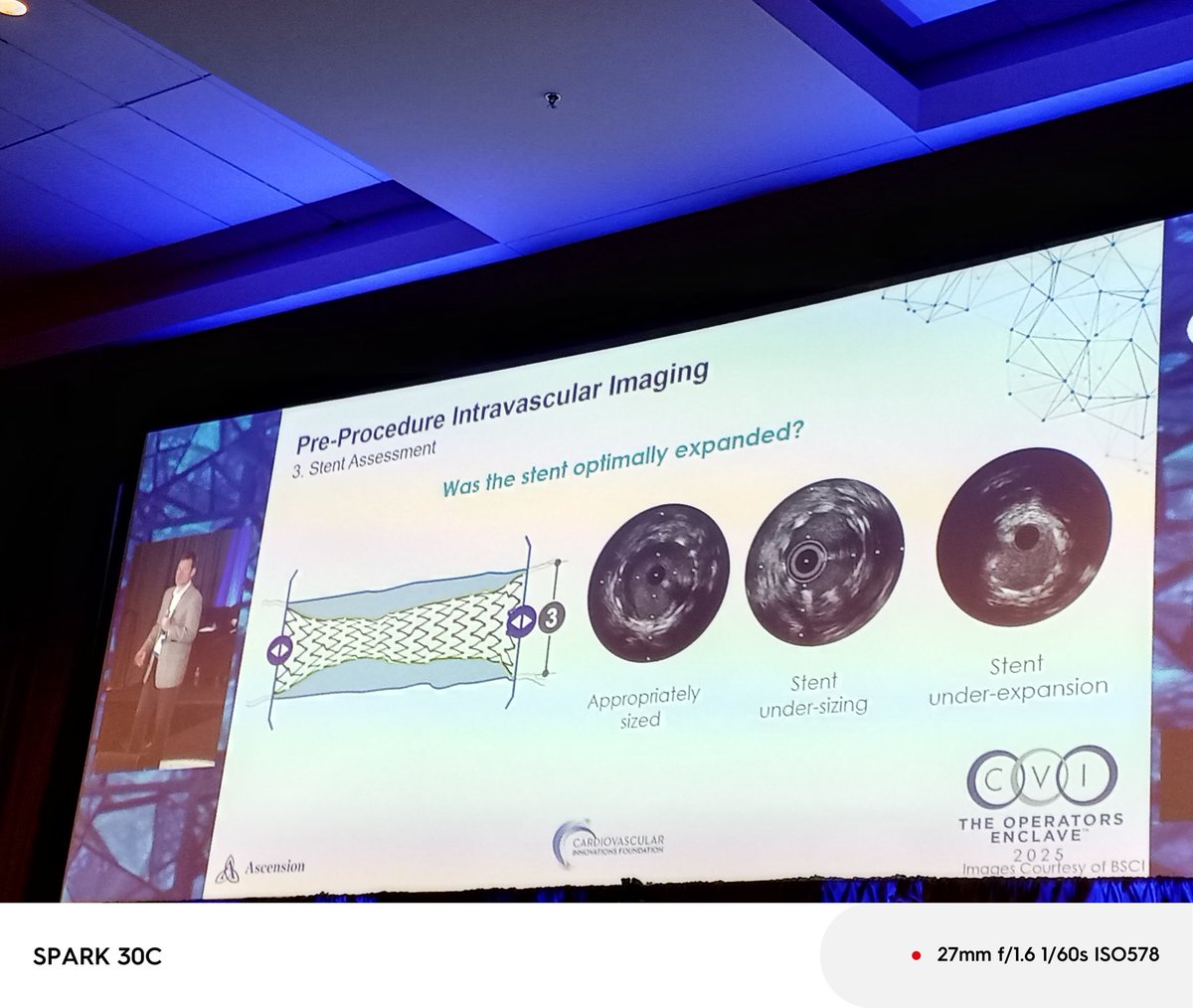 Zainab Dakhil (@zainabdakhil2) on Twitter photo Learning never stops here <a href="/cvinnovations/">CV Innovations</a> #CVI2025 Slides by <a href="/kerrigjl/">Jimmy Kerrigan</a> on #IC imaging in #StentFailure <a href="/esbrilakis/">Emmanouil Brilakis</a> <a href="/arnoldseto/">Dr. Seto</a> <a href="/FaroucJaffer/">Farouc Jaffer MD PhD</a> <a href="/shishem/">Mehdi Shishehbor, DO</a> <a href="/psorajja/">Paul</a> <a href="/timir_paul/">Timir Paul, MD, PhD, FACC, FSCAI, FAHA</a> <a href="/Pooh_Velagapudi/">Poonam Velagapudi</a> <a href="/rajivxgulati/">Rajiv Gulati</a> <a href="/RhianEDavies1/">Rhian E. Davies DO MS</a> <a href="/calmanoj/">Manoj Kesarwani, MD (he/him/his)</a> <a href="/GutoDallan/">GutoDallan</a> <a href="/HarisPatail/">Haris Patail MD</a> <a href="/HenrytTimothy/">Timothy Henry</a> <a href="/OlgaNYC1211/">Olga Lautman 🇺🇸🇺🇦</a> Learning never stops here <a href="/cvinnovations/">CV Innovations</a> #CVI2025 Slides by <a href="/kerrigjl/">Jimmy Kerrigan</a> on #IC imaging in #StentFailure <a href="/esbrilakis/">Emmanouil Brilakis</a> <a href="/arnoldseto/">Dr. Seto</a> <a href="/FaroucJaffer/">Farouc Jaffer MD PhD</a> <a href="/shishem/">Mehdi Shishehbor, DO</a> <a href="/psorajja/">Paul</a> <a href="/timir_paul/">Timir Paul, MD, PhD, FACC, FSCAI, FAHA</a> <a href="/Pooh_Velagapudi/">Poonam Velagapudi</a> <a href="/rajivxgulati/">Rajiv Gulati</a> <a href="/RhianEDavies1/">Rhian E. Davies DO MS</a> <a href="/calmanoj/">Manoj Kesarwani, MD (he/him/his)</a> <a href="/GutoDallan/">GutoDallan</a> <a href="/HarisPatail/">Haris Patail MD</a> <a href="/HenrytTimothy/">Timothy Henry</a> <a href="/OlgaNYC1211/">Olga Lautman 🇺🇸🇺🇦</a>