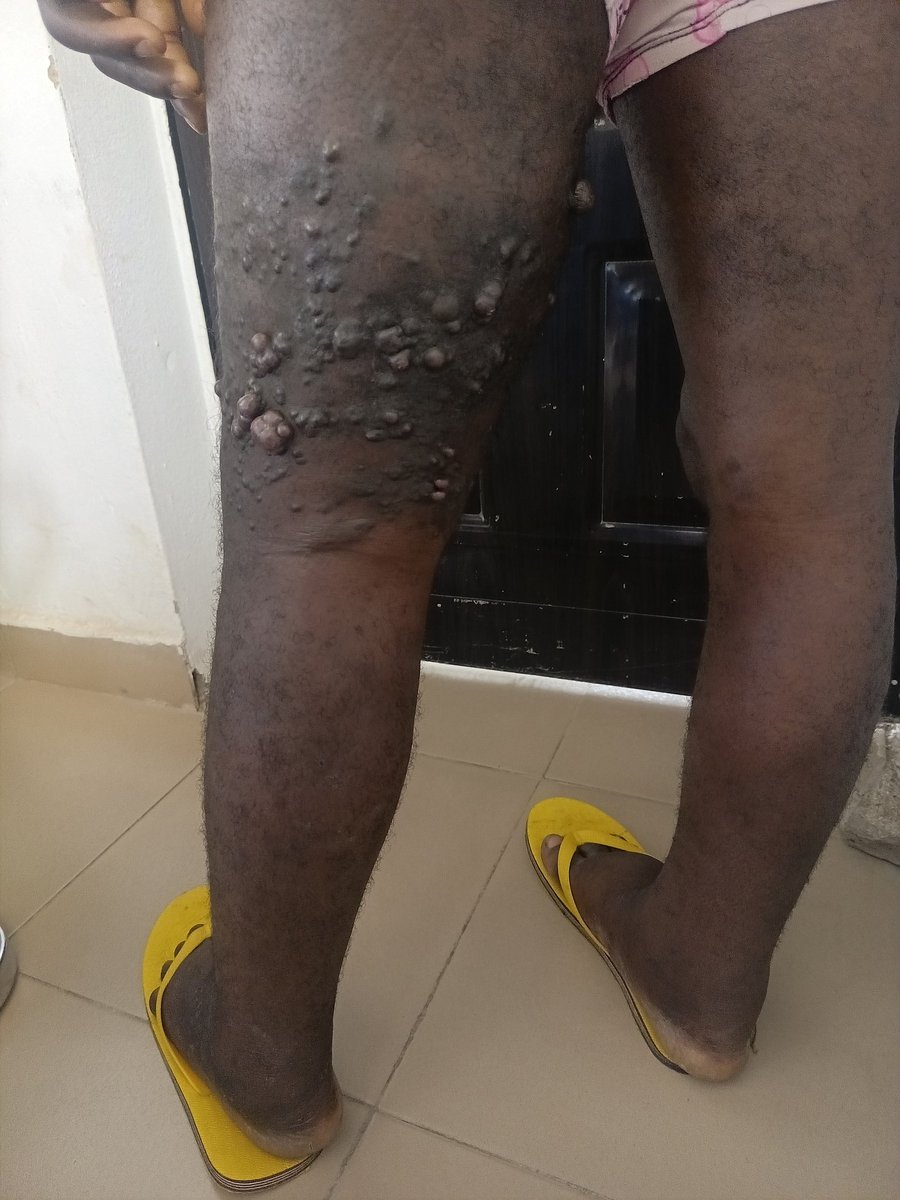 drHUAffan's tweet photo. Patient is a 22 year old who presented with swelling of both lower limbs and Unilateral Swelling of upper limb. 
Swelling was said to started developing about 7 years ago. 
Initially Unilateral lower limb, progressively involved the other limb including the Upper limb recently. https://t.co/kdqcTn9TD9