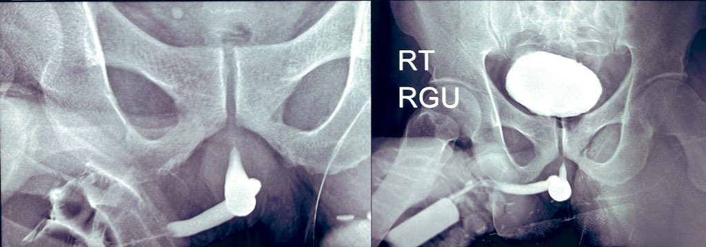 DrSanjayPande10's tweet photo. “Stretch serves organs straight” !! laxity at #retrogradeurethrogram failed to reveal much needed urethral segment pathology in investigative #urology Some investigations can be polished to absolute clarity. An opportunity lost in assessment of #stricture #urethra @SIU_Journal
@BAUSurology @Uroweb @AmerUrological