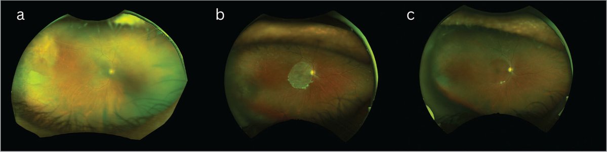 IMAGES in #Ophthalmology: 

Figure 1. Color fundus photography (CFP) of the right eye demonstrating (A) full-thickness macular hole measuring 780 µm in diameter before amniotic membrane graft. 

Read more: tinyurl.com/234d9kks

#ophthalmology #retina