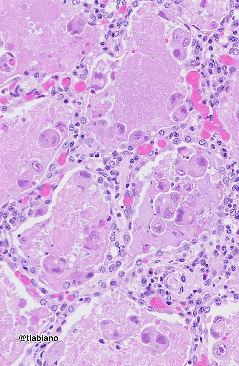 Tania Labiano (@tlabiano) on Twitter photo CMV pneumonia in an immunocompromised patient. Inspired by <a href="/Quique_rs/">Quique Revilla</a> 🙏Your BAL pic is amazing! 🤩🔝
#forcytohistocorrelationlovers
🔬🧩🧠🔥🖱️
x.com/quique_rs/stat…
#pulmpath #cytopath #TGIF <a href="/byrk_bsr/">Busra YAPRAK BAYRAK</a> <a href="/carmen_ap7/">Carmen A.</a> <a href="/pepeheffernan/">Pepe Jiménez Heffernan</a> <a href="/mezeitibi/">Tibor Mezei</a> <a href="/kriyer68/">Kalyani Bambal</a> CMV pneumonia in an immunocompromised patient. Inspired by <a href="/Quique_rs/">Quique Revilla</a> 🙏Your BAL pic is amazing! 🤩🔝
#forcytohistocorrelationlovers
🔬🧩🧠🔥🖱️
x.com/quique_rs/stat…
#pulmpath #cytopath #TGIF <a href="/byrk_bsr/">Busra YAPRAK BAYRAK</a> <a href="/carmen_ap7/">Carmen A.</a> <a href="/pepeheffernan/">Pepe Jiménez Heffernan</a> <a href="/mezeitibi/">Tibor Mezei</a> <a href="/kriyer68/">Kalyani Bambal</a>