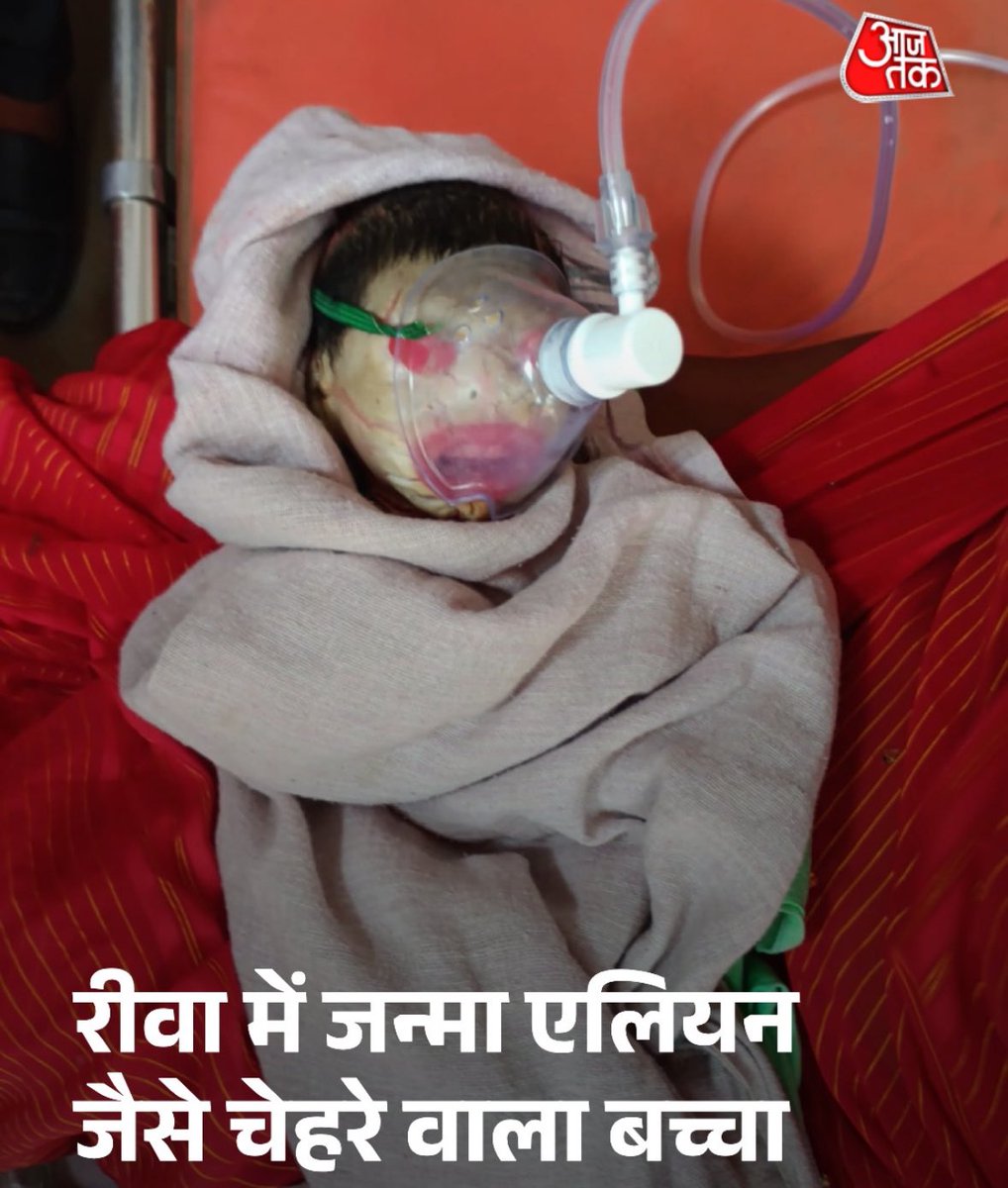 Dear <a href="/aajtak/">AajTak</a> this is called Harlequin type ichthyosis: A genetic disorder of new born and is not any Alien type face

What kinda journalism is this at least learn from a doctor first before writing such stupid title.